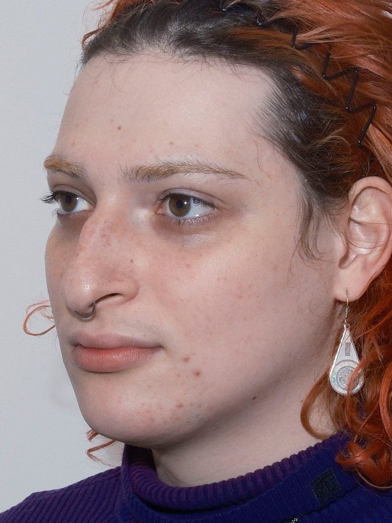 Genioplasty Before & After Gallery - Patient 126208 - Image 3