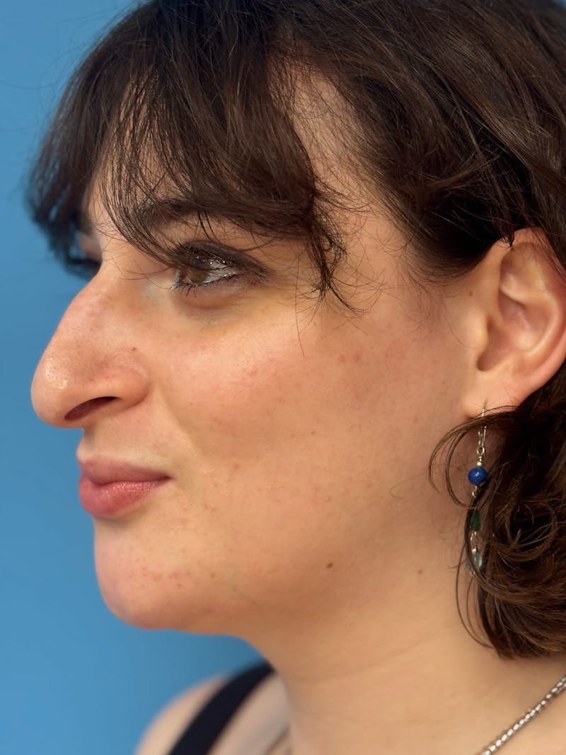 Genioplasty Before & After Gallery - Patient 126208 - Image 4