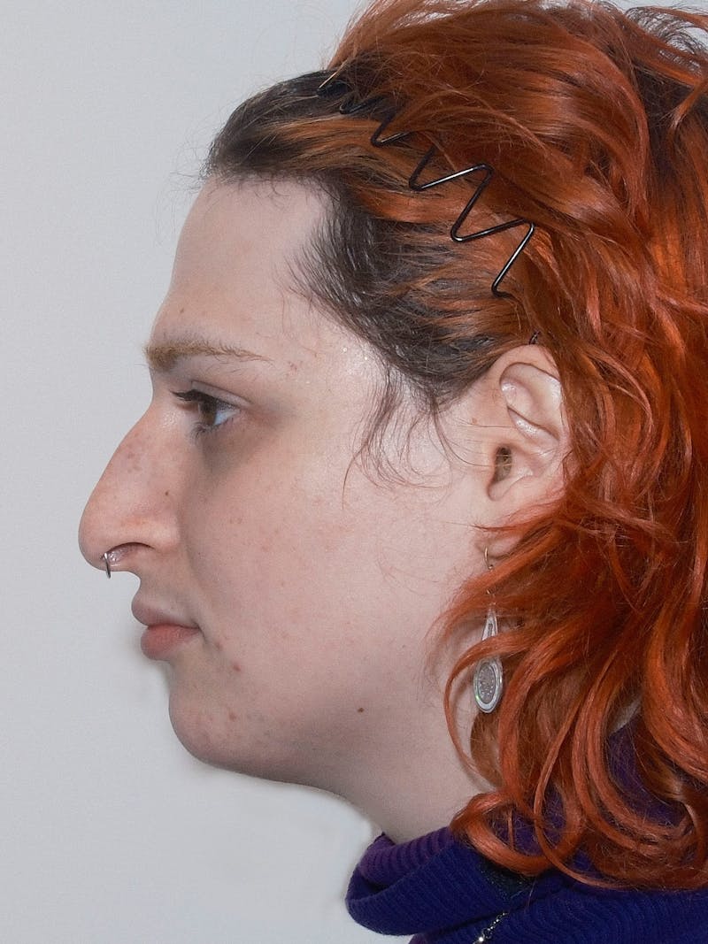 Genioplasty Before & After Gallery - Patient 126208 - Image 5