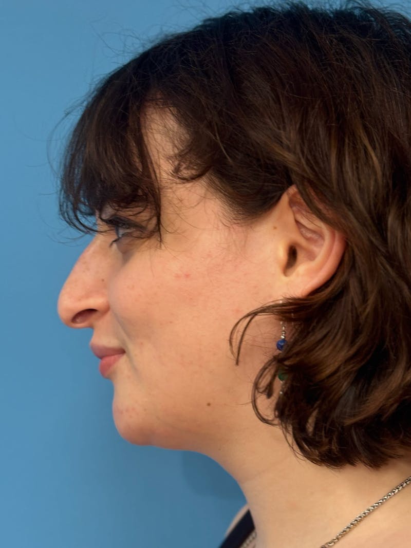 Genioplasty Before & After Gallery - Patient 126208 - Image 6