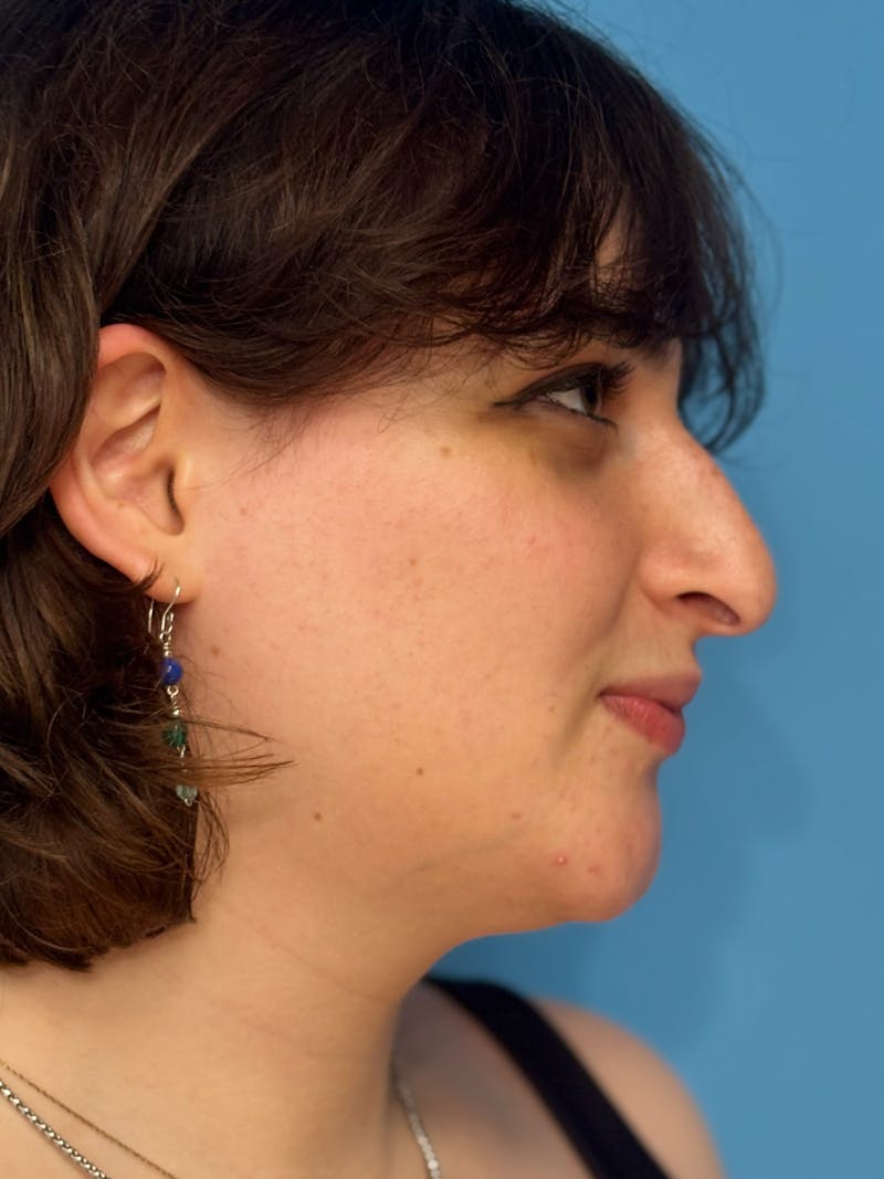 Genioplasty Before & After Gallery - Patient 126208 - Image 8