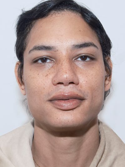 Genioplasty Before & After Gallery - Patient 165377 - Image 1