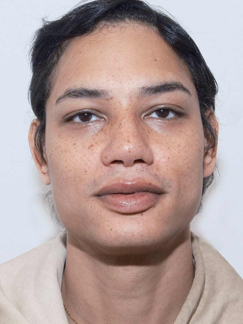 Genioplasty Before & After Gallery - Patient 165377 - Image 1