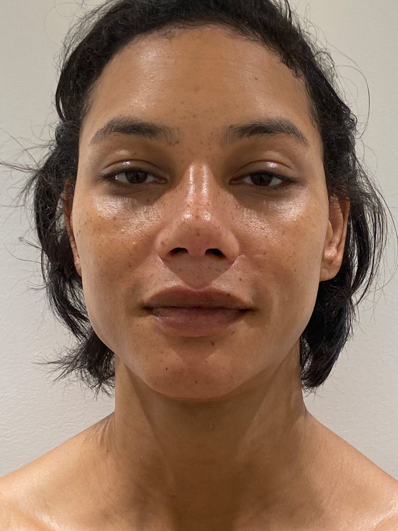 Genioplasty Before & After Gallery - Patient 165377 - Image 2