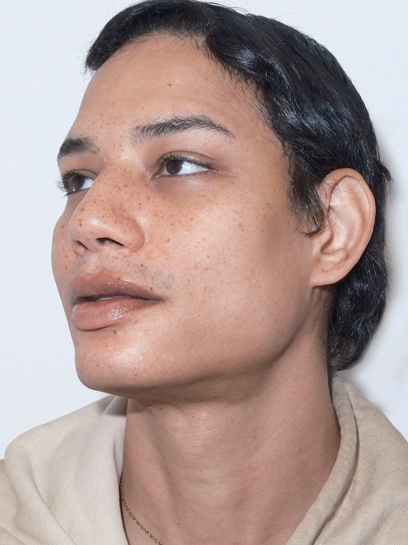 Genioplasty Before & After Gallery - Patient 165377 - Image 3