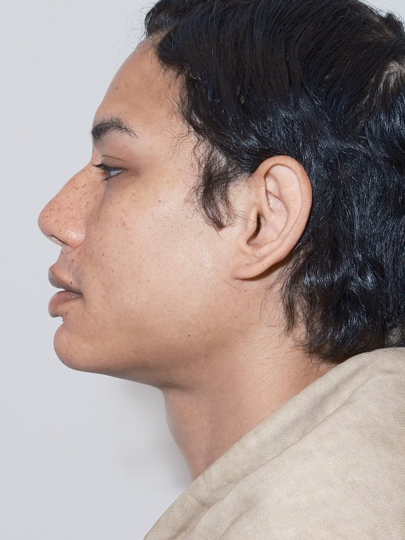 Genioplasty Before & After Gallery - Patient 165377 - Image 5