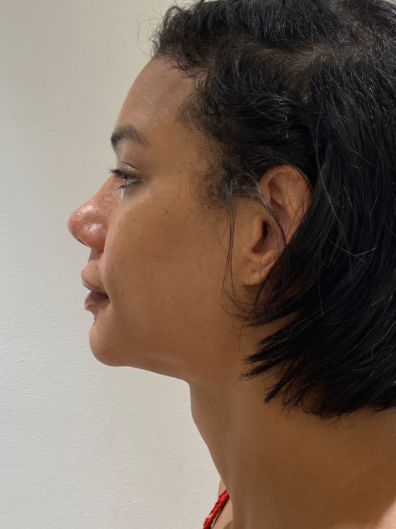 Genioplasty Before & After Gallery - Patient 165377 - Image 6