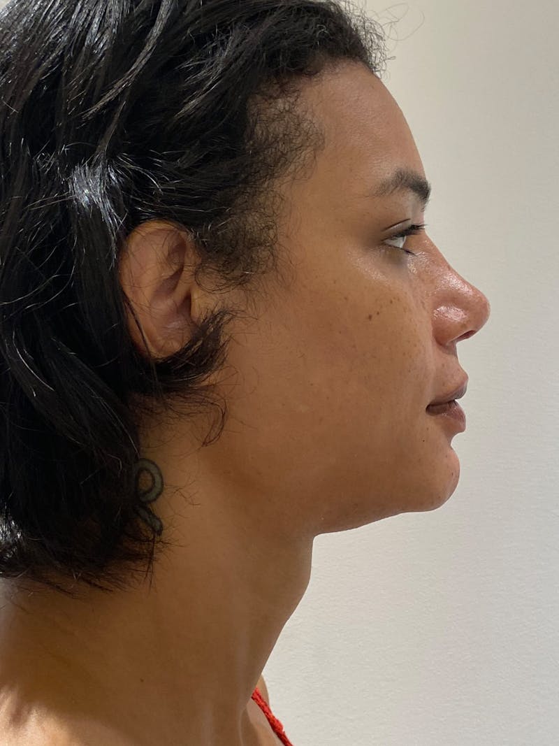 Genioplasty Before & After Gallery - Patient 165377 - Image 8