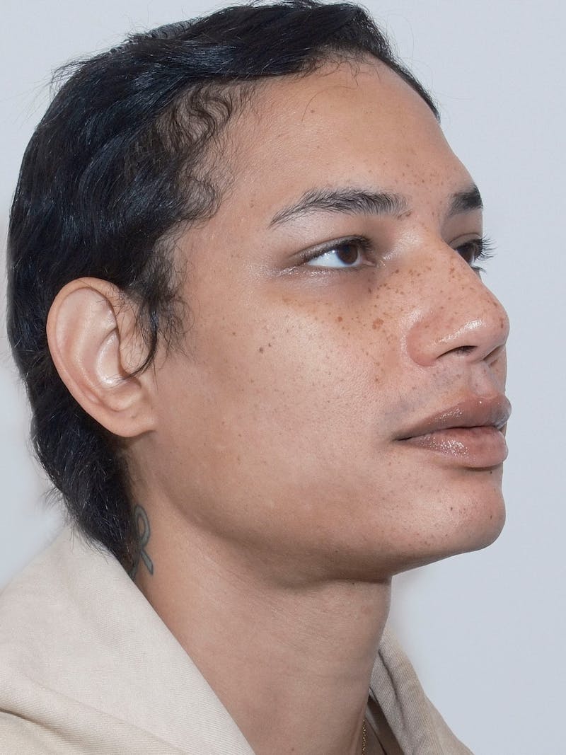 Genioplasty Before & After Gallery - Patient 165377 - Image 9