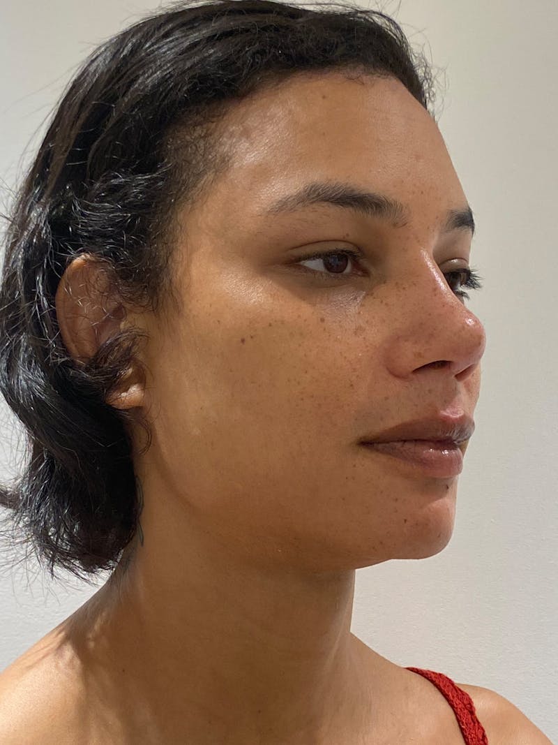 Genioplasty Before & After Gallery - Patient 165377 - Image 10
