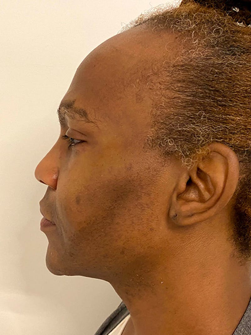 Case Studies Before & After Gallery - Patient 347232 - Image 6