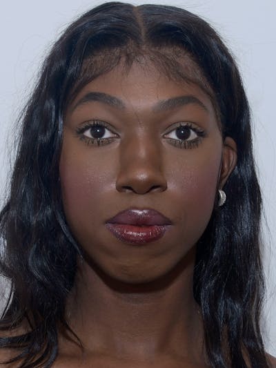 Mandible Angles Before & After Gallery - Patient 191041 - Image 1