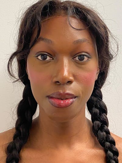 Mandible Angles Before & After Gallery - Patient 191041 - Image 2