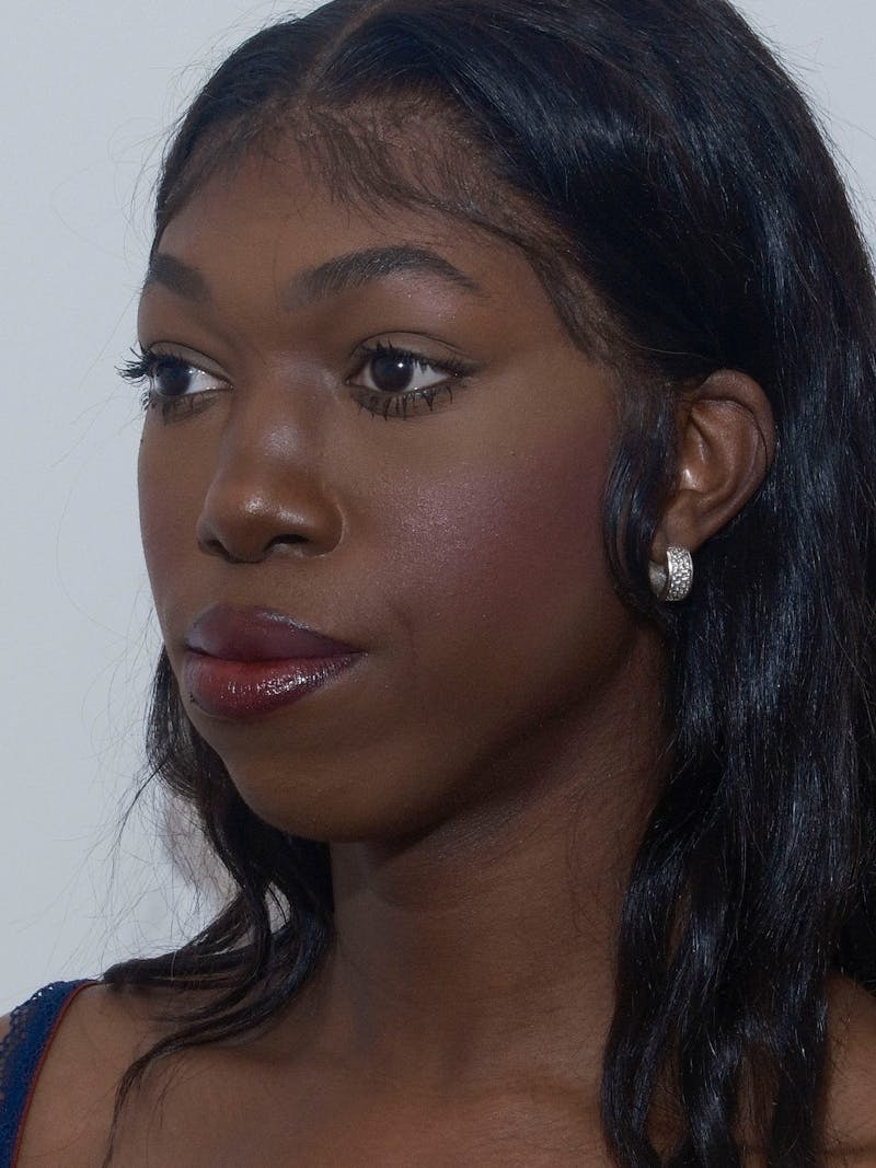 Mandible Angles Before & After Gallery - Patient 191041 - Image 3