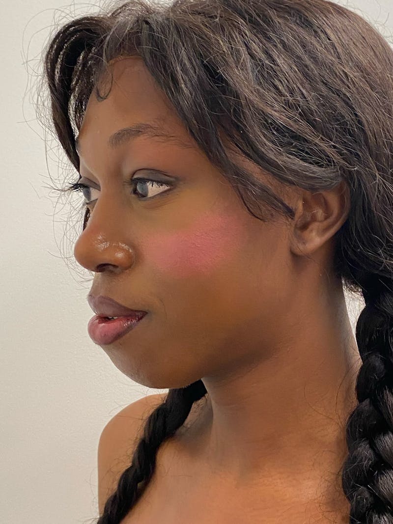 Mandible Angles Before & After Gallery - Patient 191041 - Image 4