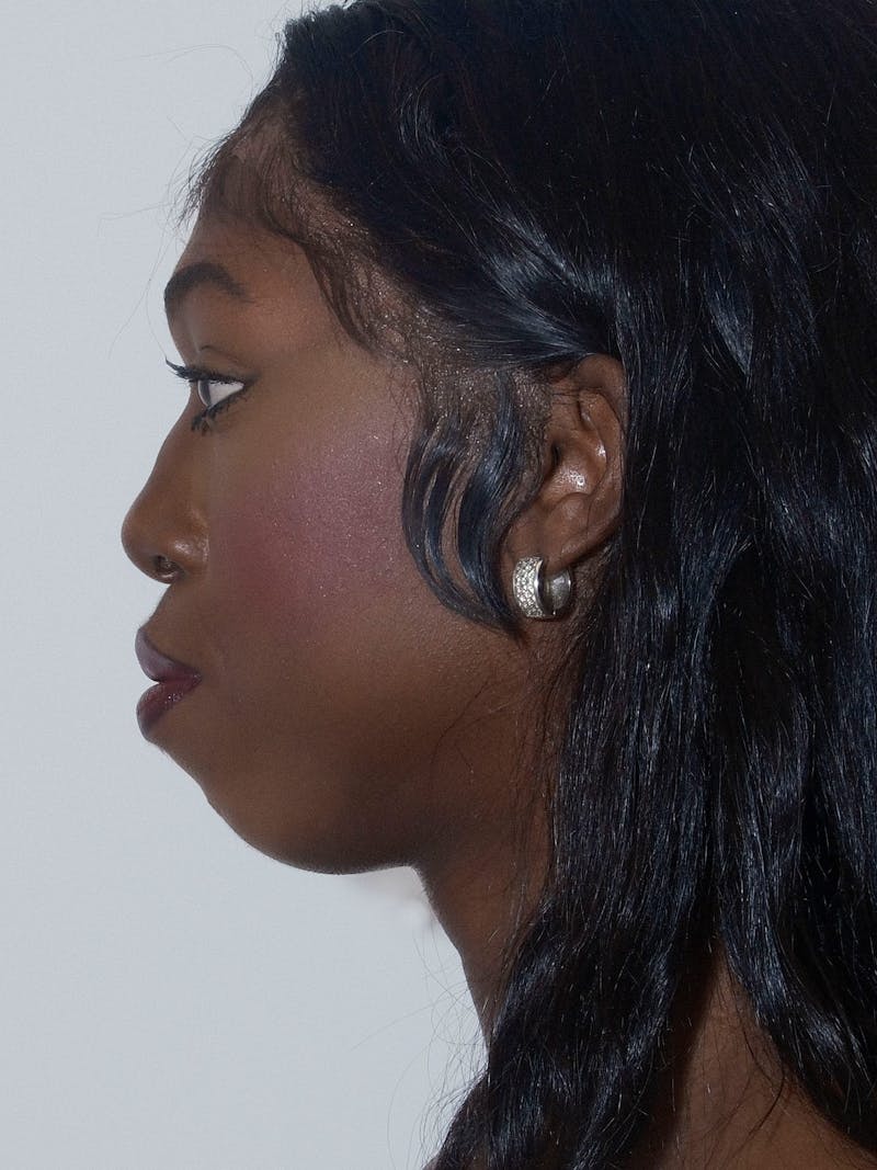 Mandible Angles Before & After Gallery - Patient 191041 - Image 5