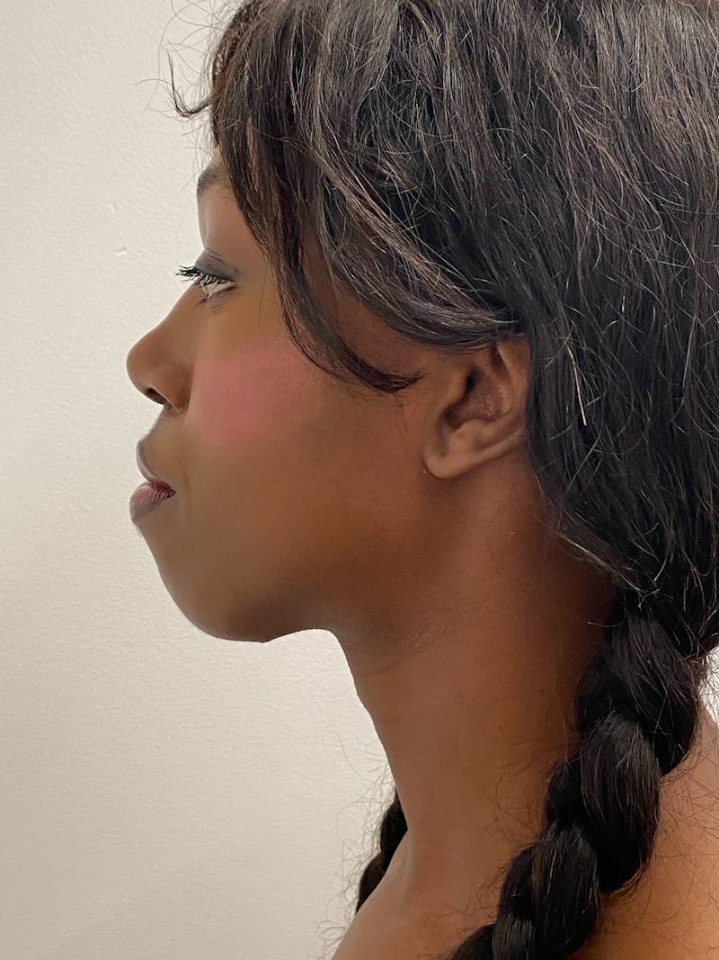 Mandible Angles Before & After Gallery - Patient 191041 - Image 6