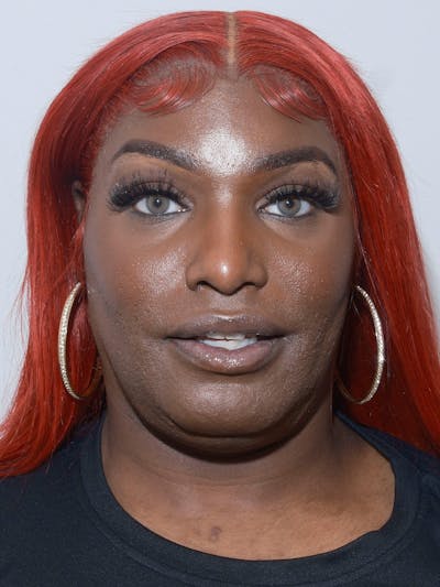 Forehead Reduction Before & After Gallery - Patient 400528 - Image 2