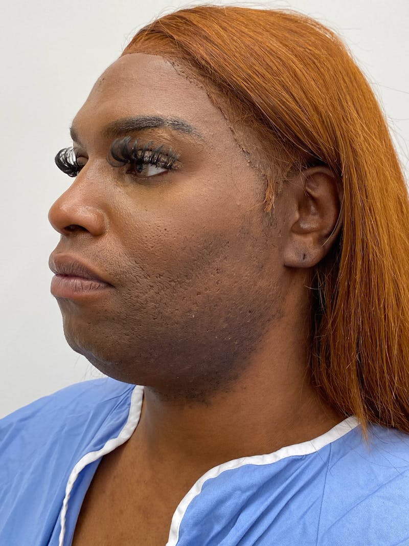 Forehead Reduction Before & After Gallery - Patient 400528 - Image 3