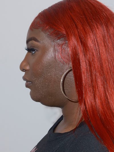 Brow Bone Reduction Before & After Gallery - Patient 877729 - Image 2