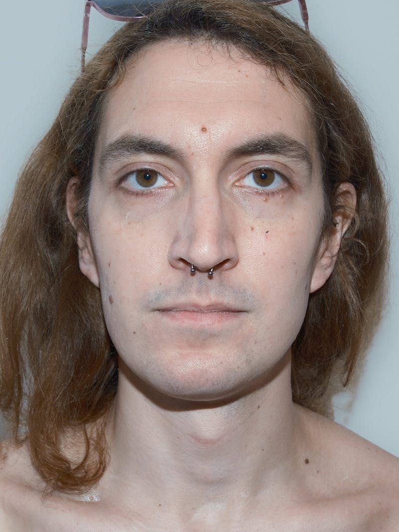 Forehead Reduction Before & After Gallery - Patient 385334 - Image 1