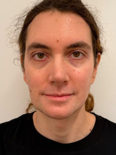 Forehead Reduction Before & After Gallery - Patient 385334 - Image 2