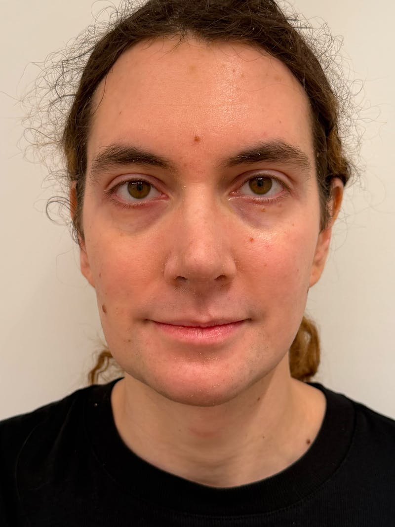 Forehead Reduction Before & After Gallery - Patient 385334 - Image 2