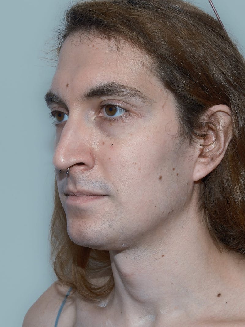 Forehead Reduction Before & After Gallery - Patient 385334 - Image 3