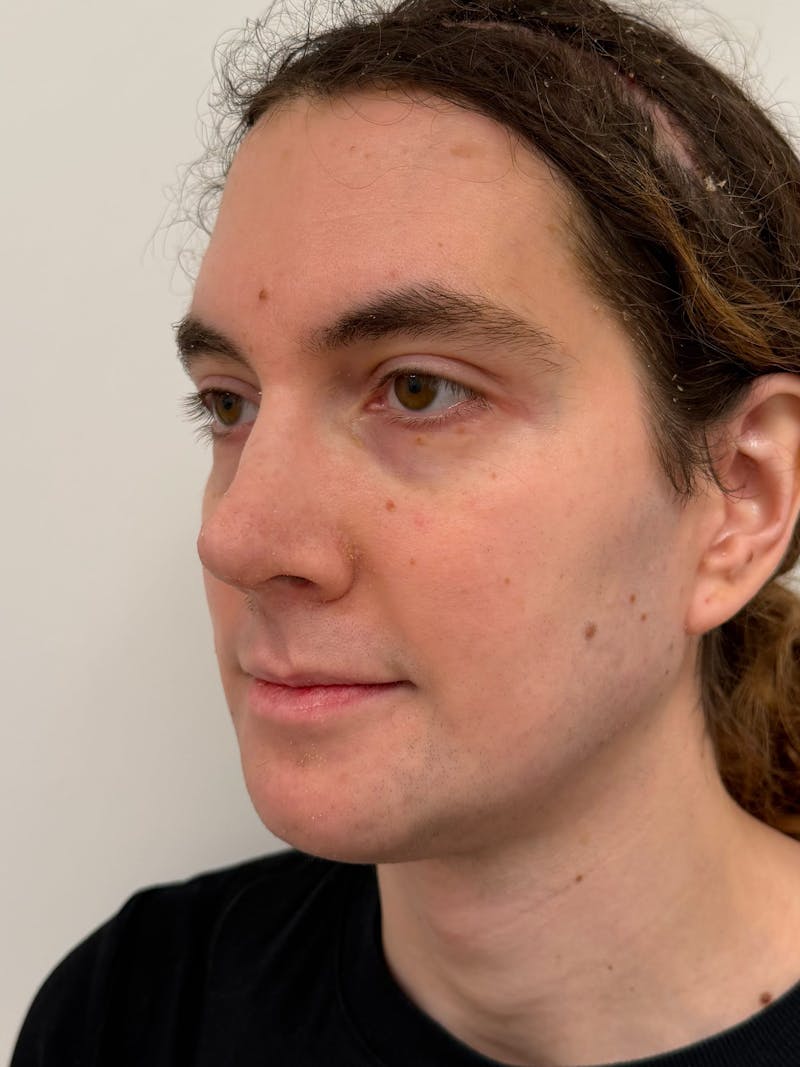 Forehead Reduction Before & After Gallery - Patient 385334 - Image 4