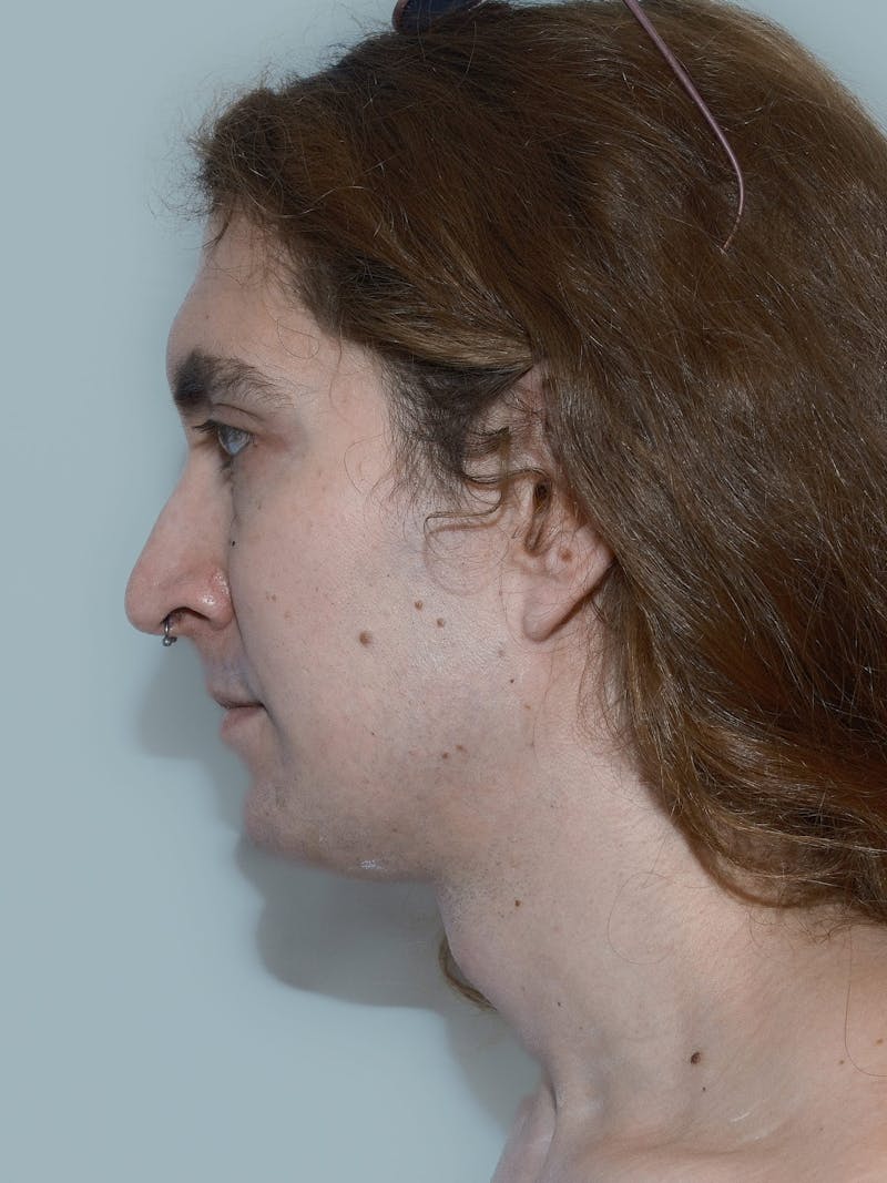 Forehead Reduction Before & After Gallery - Patient 385334 - Image 5