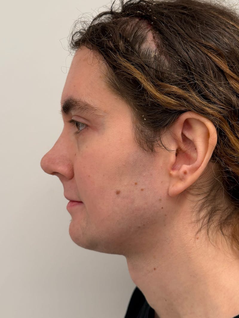 Forehead Reduction Before & After Gallery - Patient 385334 - Image 6