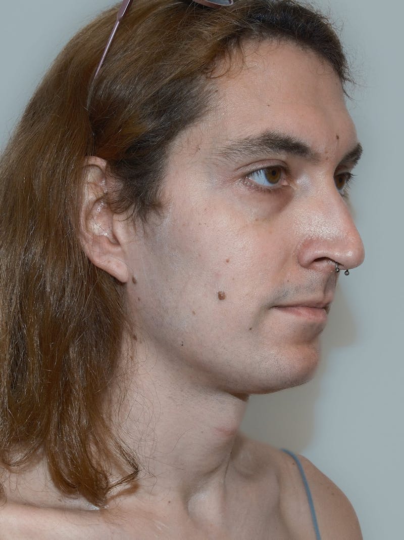 Forehead Reduction Before & After Gallery - Patient 385334 - Image 7