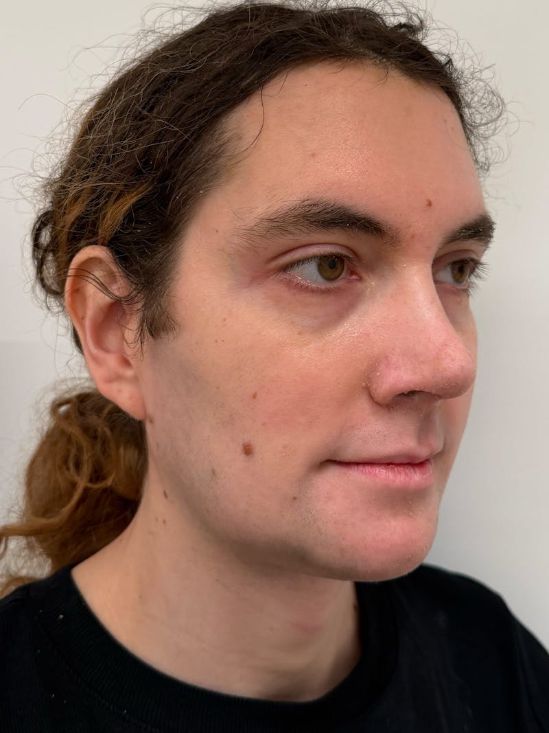 Forehead Reduction Before & After Gallery - Patient 385334 - Image 8