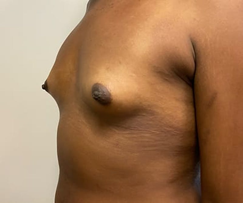 Breast Augmentation Before & After Gallery - Patient 190082 - Image 5