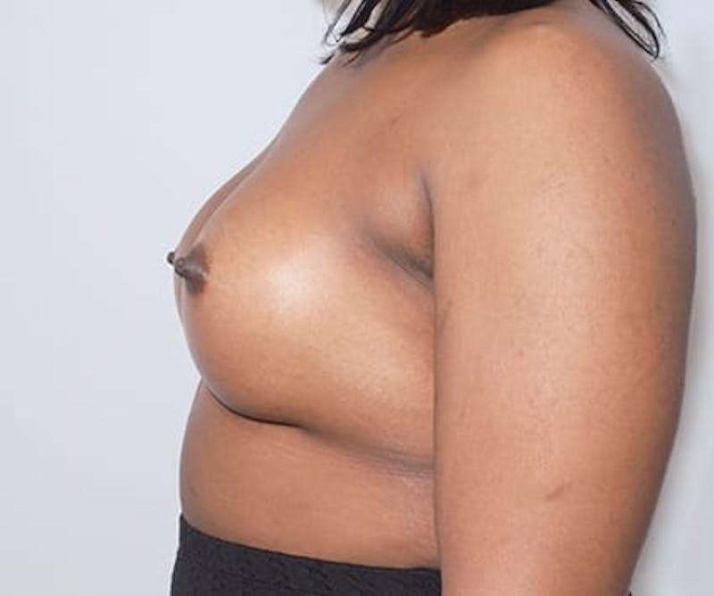 Breast Augmentation Before & After Gallery - Patient 190082 - Image 10