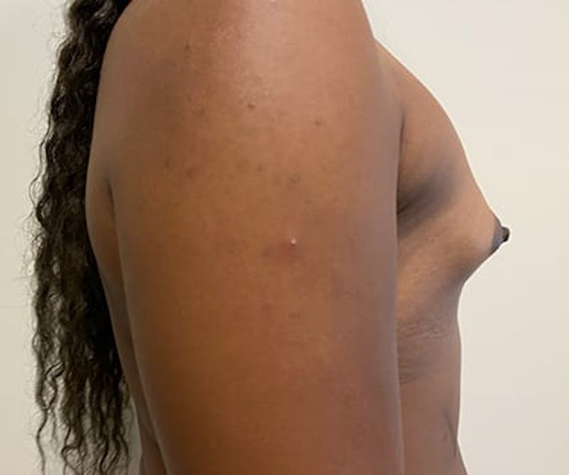 Breast Augmentation Before & After Gallery - Patient 190082 - Image 7