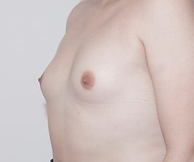 Breast Augmentation Before & After Gallery - Patient 308207 - Image 3