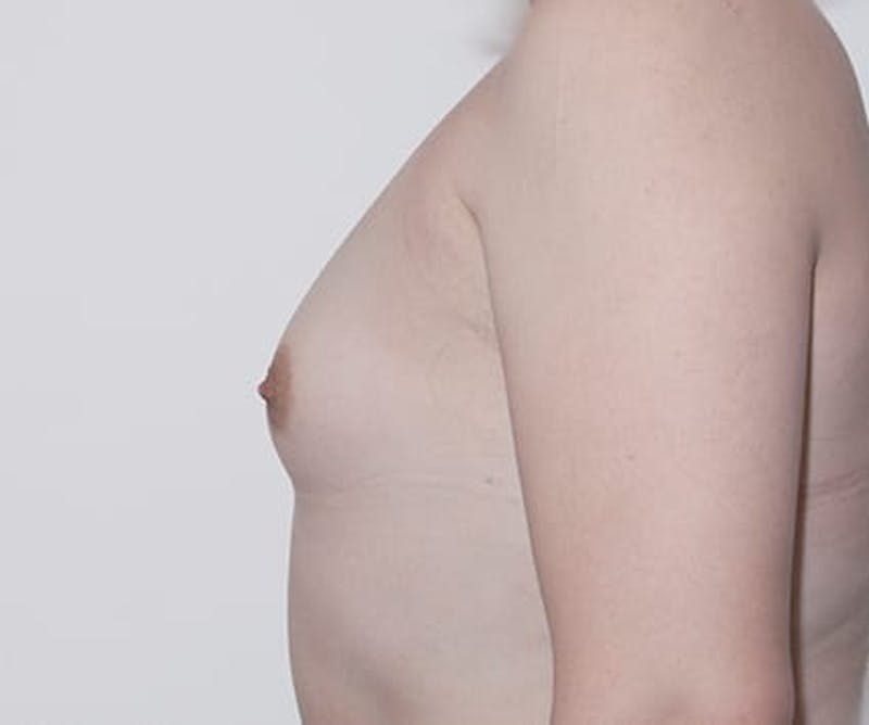Breast Augmentation Before & After Gallery - Patient 308207 - Image 5