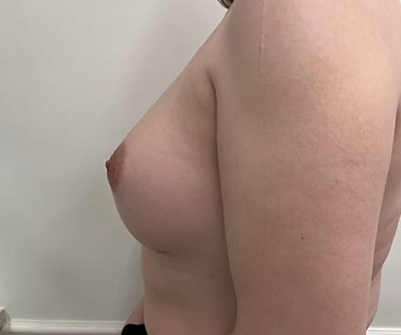 Breast Augmentation Before & After Gallery - Patient 308207 - Image 6