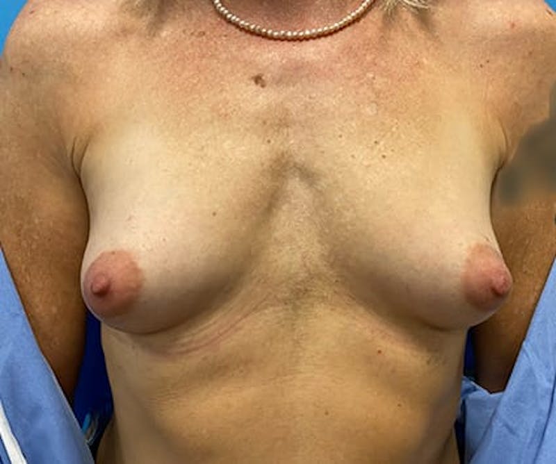 Breast Augmentation Before & After Gallery - Patient 401054 - Image 1