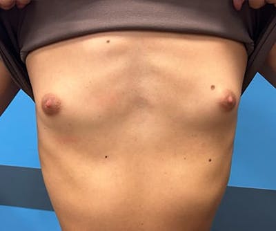 Breast Augmentation Before & After Gallery - Patient 176917 - Image 1