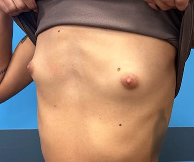 Breast Augmentation Before & After Gallery - Patient 176917 - Image 3