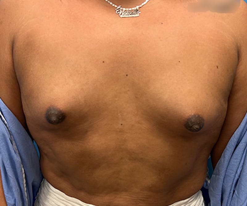 Breast Augmentation Before & After Gallery - Patient 306142 - Image 1