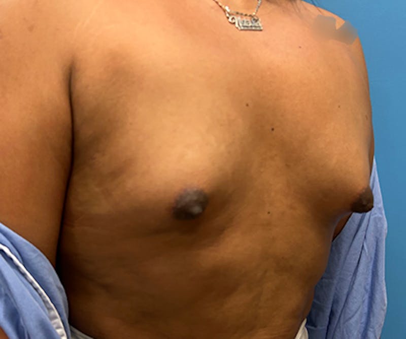 Breast Augmentation Before & After Gallery - Patient 306142 - Image 5