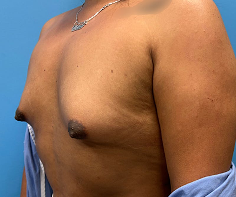 Breast Augmentation Before & After Gallery - Patient 306142 - Image 3