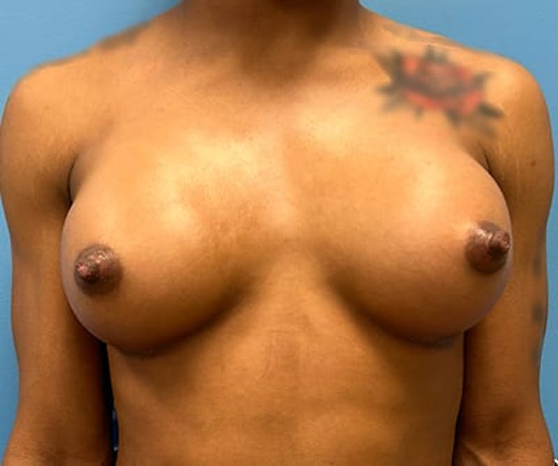 Breast Augmentation Before & After Gallery - Patient 385855 - Image 2
