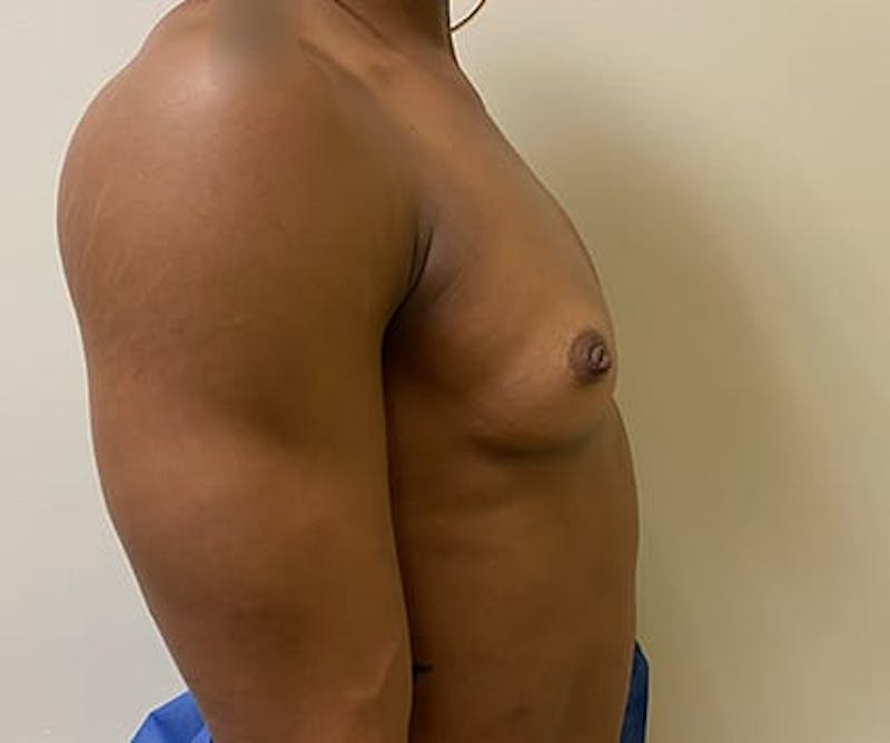 Breast Augmentation Before & After Gallery - Patient 385855 - Image 3