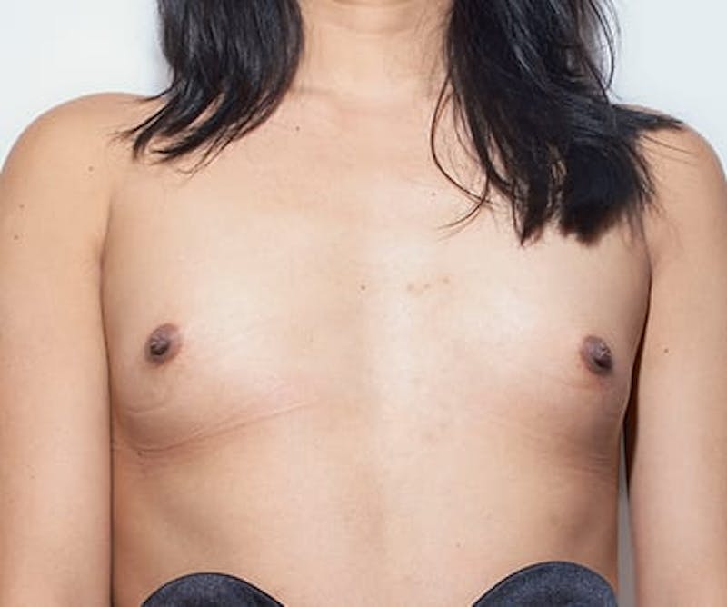 Breast Augmentation Before & After Gallery - Patient 329334 - Image 1