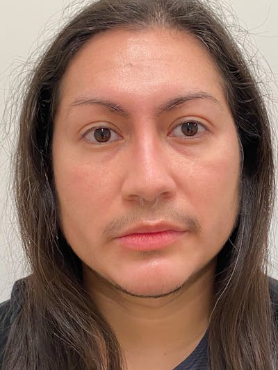 Facial Masculinization Before & After Gallery - Patient 119547 - Image 2