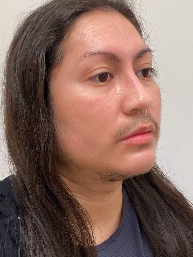 Facial Masculinization Before & After Gallery - Patient 119547 - Image 4